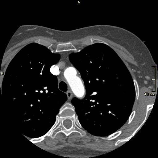 Chronic pulmonary embolism (Radiopaedia 73073-85094 Axial C+ CTPA 17).jpg