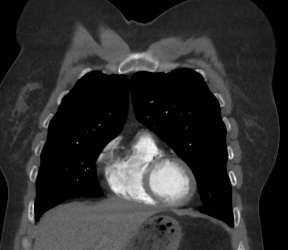 Chronic pulmonary embolus (Radiopaedia 39129-41341 Coronal C+ CTPA 26).png