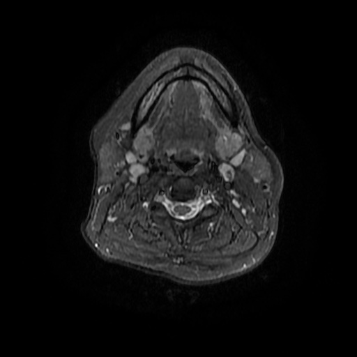 File:Chronic submandibular sialadenitis (Radiopaedia 61852-69885 Axial STIR 14).jpg