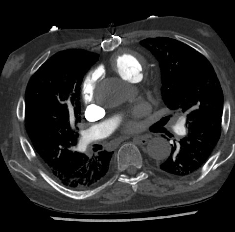 File:Chronic thromboembolic pulmonary disease (Radiopaedia 90694-108119 Axial C+ CTPA 51).jpg
