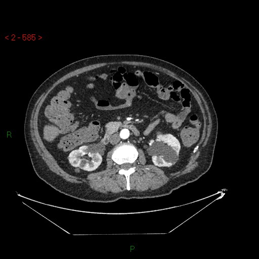 Circumaortic left renal vein and doubled left renal arteries (Radiopaedia 52268-58158 A 121).jpg