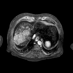 Cirrhosis and hepatocellular carcinoma in the setting of hemochromatosis (Radiopaedia 75394-86594 Axial T1 C+ fat sat 239).jpg