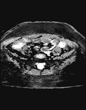 File:Class II Mullerian duct anomaly- unicornuate uterus with rudimentary horn and non-communicating cavity (Radiopaedia 39441-41755 Axial ADC 3).jpg