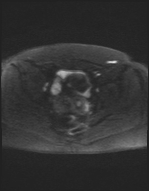 Class II Mullerian duct anomaly- unicornuate uterus with rudimentary horn and non-communicating cavity (Radiopaedia 39441-41755 Axial DWI 49).jpg
