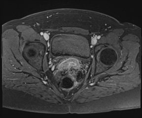 File:Class II Mullerian duct anomaly- unicornuate uterus with rudimentary horn and non-communicating cavity (Radiopaedia 39441-41755 Axial T1 fat sat 91).jpg