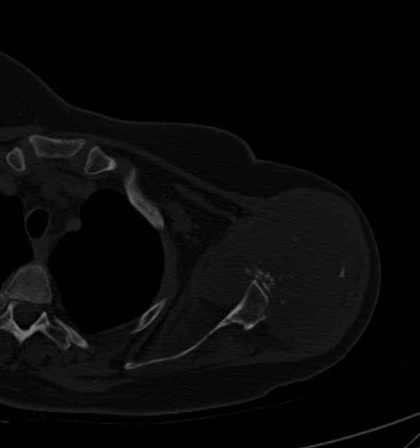 Clear cell chondrosarcoma - humerus (Radiopaedia 63104-71612 Axial bone window 40).jpg