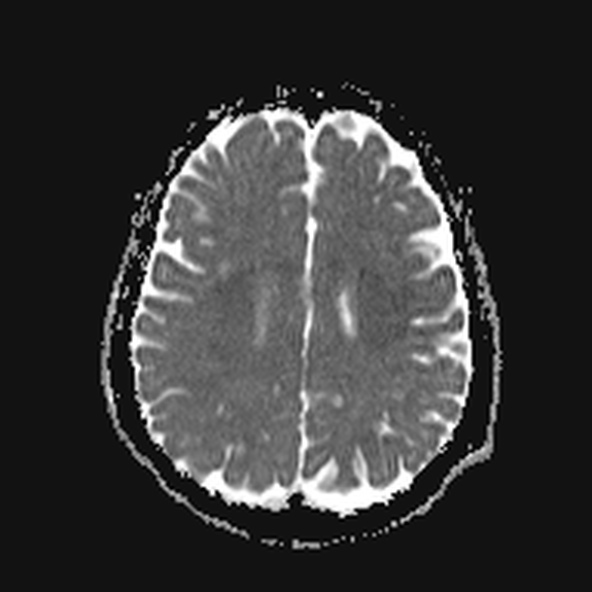 File:Clival meningioma (Radiopaedia 53278-59248 Axial ADC 17).jpg