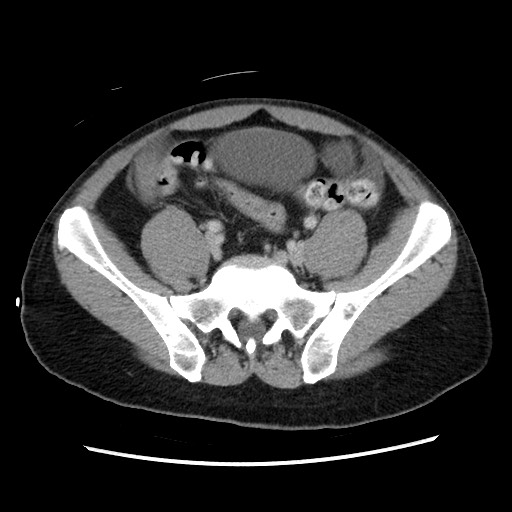 File:Closed-loop small bowel obstruction (Radiopaedia 73713-84509 A 123).jpg