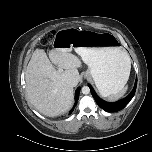 File:Closed loop obstruction - internal hernia into nephrectomy bed (Radiopaedia 59867-67320 A 29).jpg