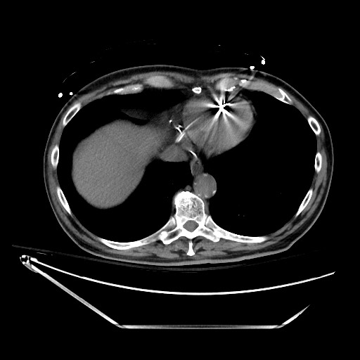 File:Closed loop obstruction due to adhesive band, resulting in small bowel ischemia and resection (Radiopaedia 83835-99023 Axial non-contrast 19).jpg