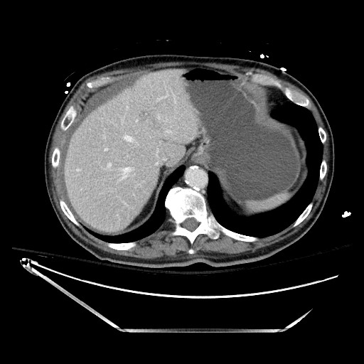 File:Closed loop obstruction due to adhesive band, resulting in small bowel ischemia and resection (Radiopaedia 83835-99023 D 33).jpg