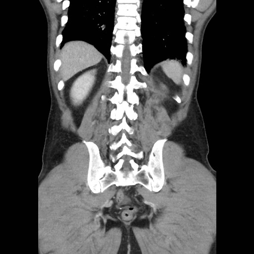 File:Closed loop small bowel obstruction (Radiopaedia 59227-66554 B 40).jpg