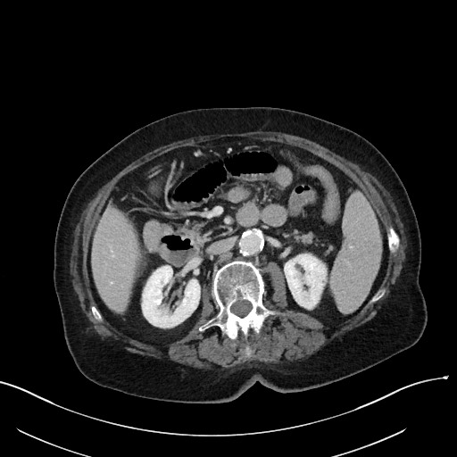 Closed loop small bowel obstruction - adhesions (Radiopaedia 59269-66611 A 53).jpg