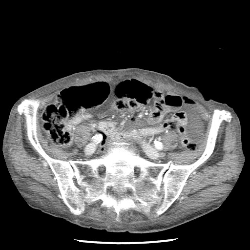 Closed loop small bowel obstruction - adhesions and infarct (Radiopaedia 85125-100678 B 70).jpg