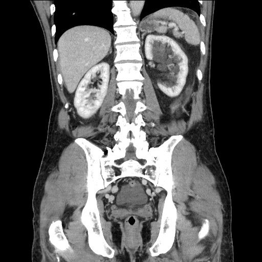 File:Closed loop small bowel obstruction - omental adhesion causing "internal hernia" (Radiopaedia 85129-100682 B 91).jpg