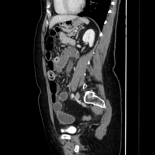 Closed loop small bowel obstruction due to adhesive bands - early and late images (Radiopaedia 83830-99015 C 112).jpg