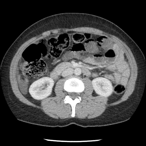 File:Closed loop small bowel obstruction due to trans-omental herniation (Radiopaedia 35593-37109 A 41).jpg