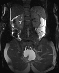 File:Closed loop small bowel obstruction in pregnancy (MRI) (Radiopaedia 87637-104031 Coronal T2 fat sat 40).jpg
