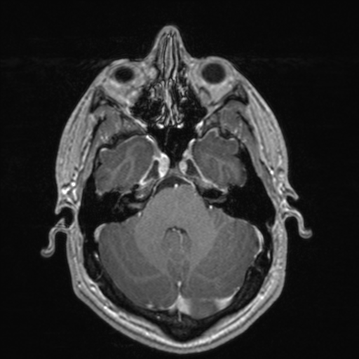 File:Colloid cyst (Radiopaedia 44510-48181 Axial T1 C+ 57).png