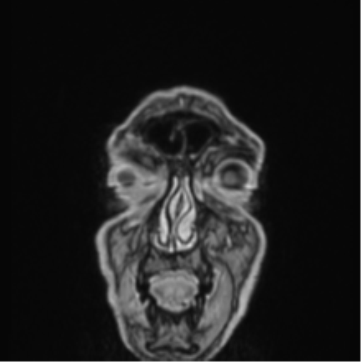 Colloid cyst of the third ventricle (Radiopaedia 86571-102662 Coronal T1 C+ 88).png