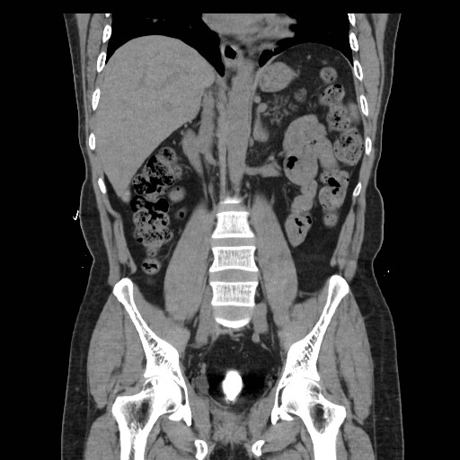 File:Colocutaneous fistula in Crohn's disease (Radiopaedia 29586-30093 E 24).jpg