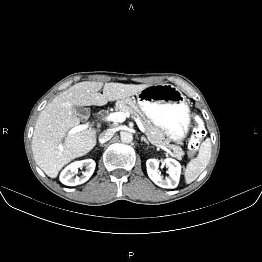 Colon adenocarcinoma - hepatic flexure (Radiopaedia 85635-101395 A 27).jpg