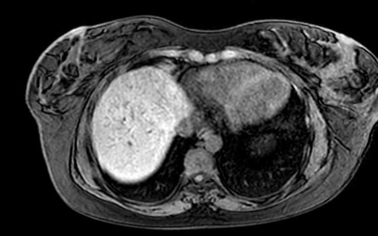File:Colon adenocarcinoma with Krukenberg tumors, advanced pregnancy (Radiopaedia 67279-76645 A 76).jpg