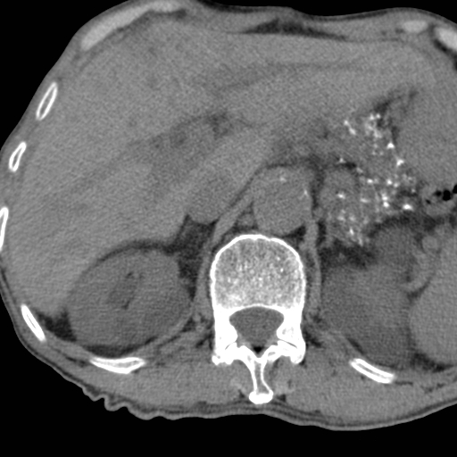 Colon cancer with calcified liver metastasis (Radiopaedia 74423-85309 Axial non-contrast 26).jpg