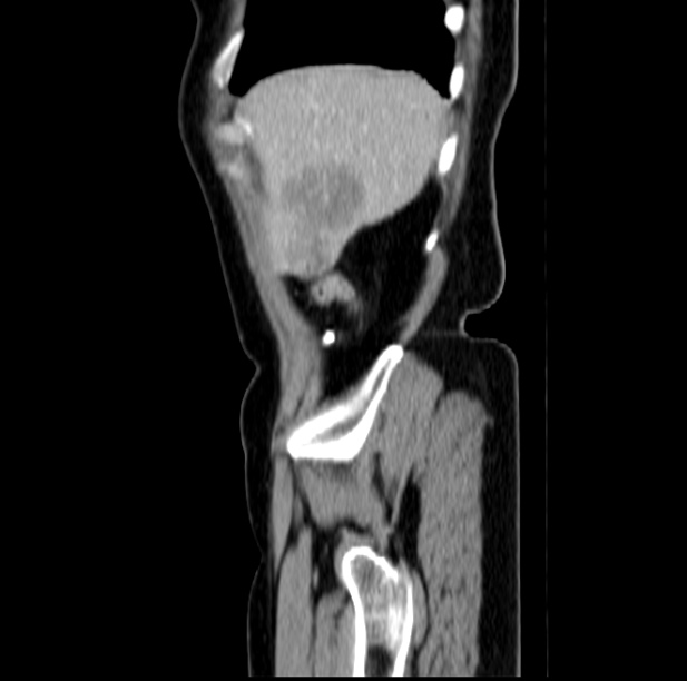 Colon carcinoma with hepatic metastases (Radiopaedia 29477-29961 C 7).jpg