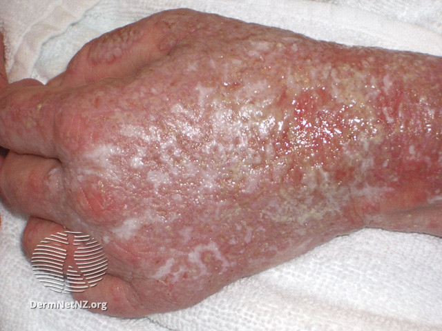 File:Eczema herpeticum (DermNet NZ viral-eczema-herpticum16).jpg