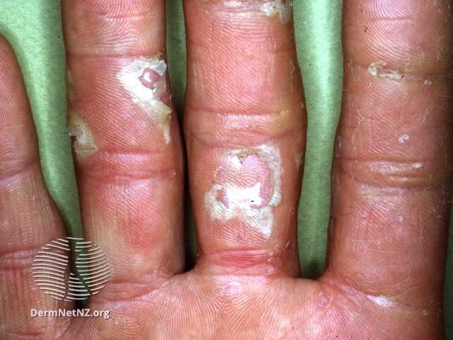 File:Exfoliative keratolysis (DermNet NZ dermatitis-keratolysis1).jpg
