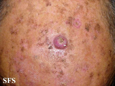 File:Keratoacanthoma (Dermatology Atlas 39).jpg