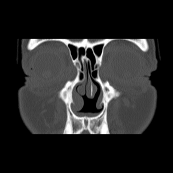File:Nasal septal perforation (Radiopaedia 25030-25289 Coronal bone window 19).jpg