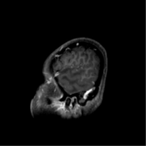Nasopharyngeal carcinoma with cerebral abscess (Radiopaedia 43018-46274 J 12).png