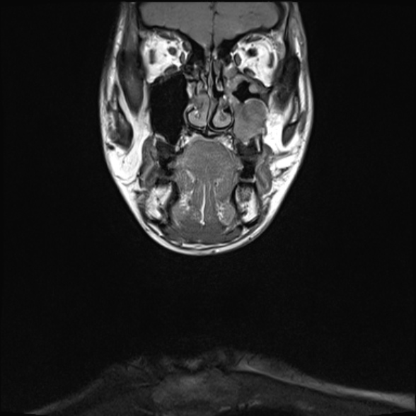 Nasopharyngeal carcinoma with skull base invasion (Radiopaedia 53415-59485 Coronal T1 33).jpg