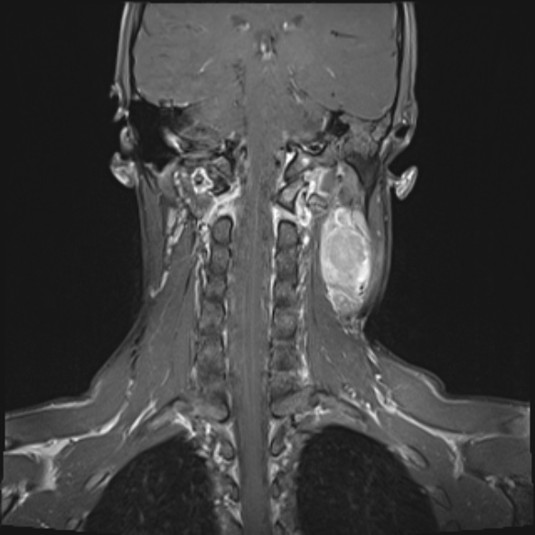 Nasopharyngeal carcinoma with skull base invasion (Radiopaedia 53415-59485 E 9).jpg