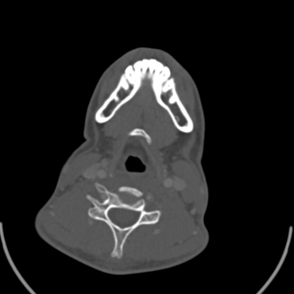 Nasopharyngeal carcinoma with skull base invasion (Radiopaedia 53415-59705 Axial bone window 137).jpg