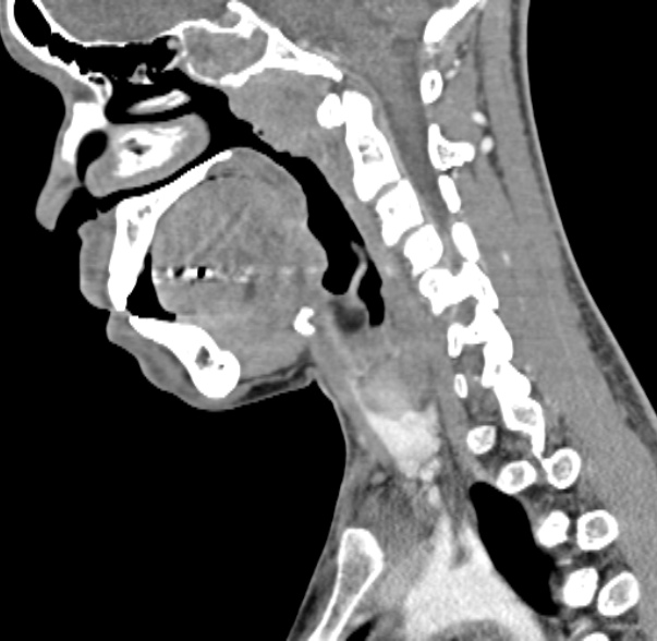 Nasopharyngeal carcinoma with skull base invasion (Radiopaedia 53415-59705 C 37).jpg