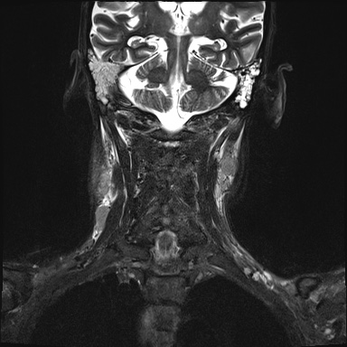 Nasopharyngeal carcinoma with skull base invasion (Radiopaedia 59258-66600 Coronal T2 fat sat 6).jpg