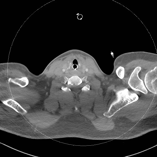 Neck CT angiogram (intraosseous vascular access) (Radiopaedia 55481-61945 B 144).jpg