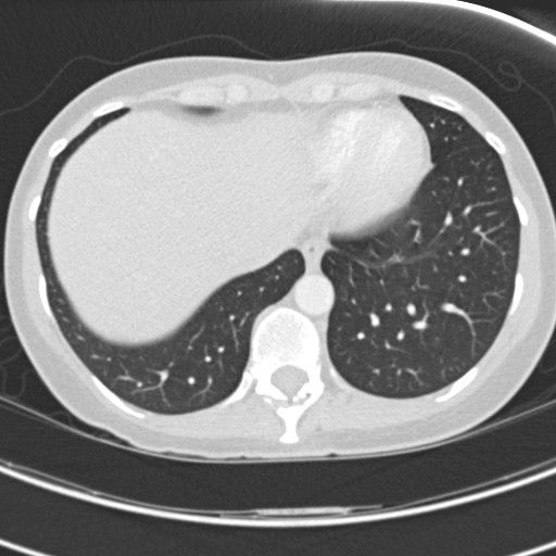 Necrobiotic pulmonary nodules - Crohn disease (Radiopaedia 20723-20631 Axial lung window 114).jpg