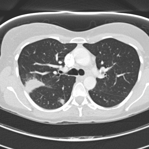 Necrobiotic pulmonary nodules - Crohn disease (Radiopaedia 20723-20631 Axial lung window 51).jpg