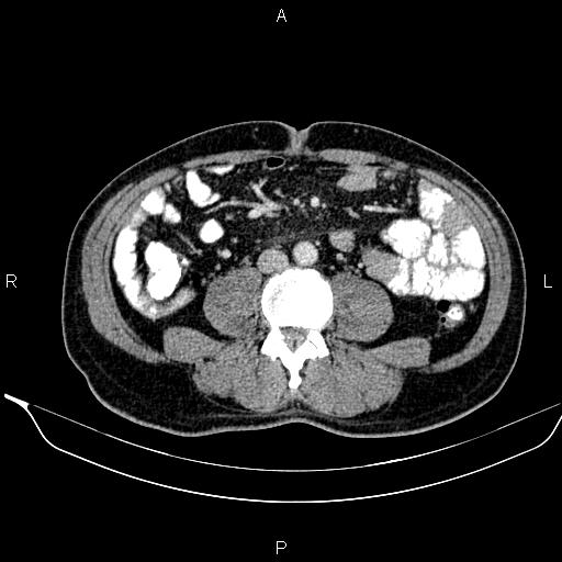 Necrotizing pancreatitis (Radiopaedia 87796-104249 A 33).jpg