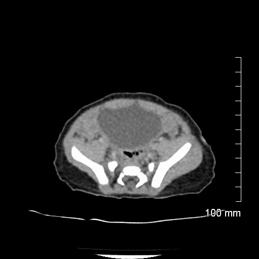 File:Neonatal neuroblastoma (Radiopaedia 56651-63438 Axial non-contrast 64).jpg