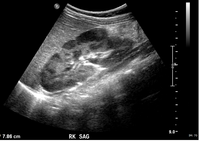 File:Nephroblastomatosis (Radiopaedia 39984-42470 B 1).png
