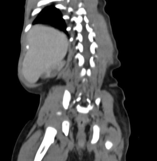 Nephroblastomatosis (Radiopaedia 71294-81607 B 278).jpg