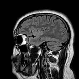 File:Neuro-Behcet's disease (Radiopaedia 21557-21506 Sagittal FLAIR 27).jpg