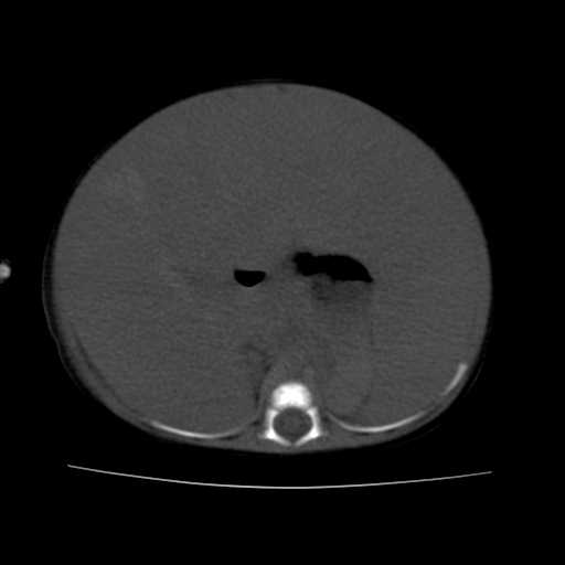 File:Neuroblastoma (Radiopaedia 20876-20799 Axial non-contrast 10).jpg