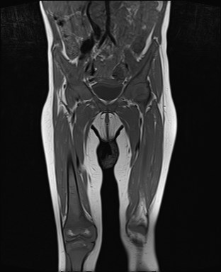 File:Neuroblastoma with bone metastases (Radiopaedia 67080-76414 Coronal T1 9).jpg