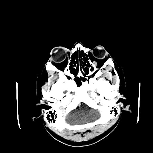 File:Neurofibromatosis type 2 (Radiopaedia 25389-25637 Axial C+ 8).jpg